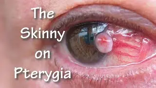 The Skinny on Pterygia