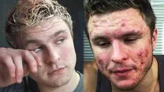 The Worst Day of My Life (MY ACNE STORY)