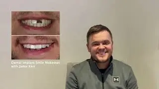 Sam's Dental Implant Experience