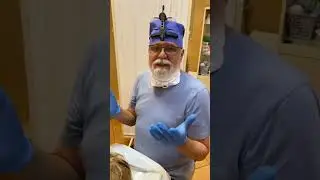 Удаление атеромы на лице за 2 минуты
