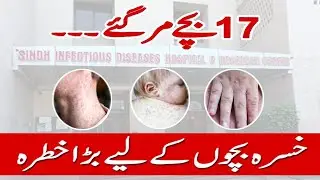 Measles Outbreak: 17 Children Lost | A Deadly Threat to Kids |       خسرہ، بچوں کے لیے بڑا خطرہ