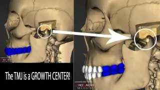 KIDS & TMJ PROBLEMS - lifelong consequences!  With Dr. Mark Piper & Dr. Nick Yiannios