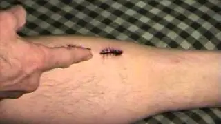 How to REMOVE STITCHES , DOES IT HURT ?  Find out here. DIY