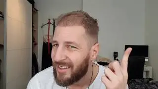 hair transplant turkey result 15 weeks