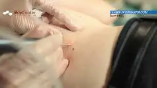 Il laser CO2 per rimozioni cicatrici acne, nei ed inestetismi