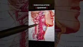 Позвоночная артерия / Сдавление 