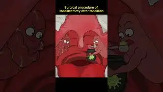 Surgical procedure of tonsillectomy
