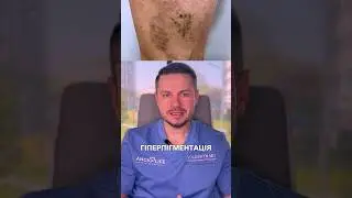 😳 Ускладнення склеротерапіі 🤯