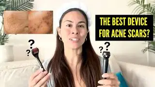 Comparing Microneedling Devices for Acne Scars | Which one is BEST?