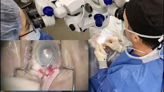Using the EndoSerter PL (Pre Loaded) by CorneaGen for DSEK