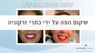 טיפולי שיניים בטורקיה עם ביונד סמייל - שיקום מלא בטורקיה על ידי שתלים וכתרים