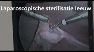 Laparoscopische sterilisatie leeuw