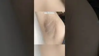 You Won’t Believe This Underarm Transformation! 😲 #ytshorts #shorts #explore #explorepage #trending