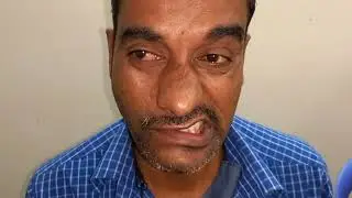 Facial palsy LMN (Bells Palsy)