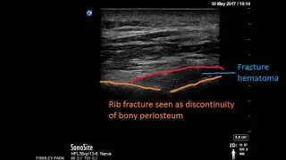 Ultrasound diagnosis of Rib fractures