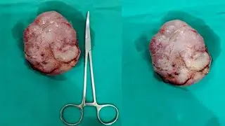 Giant fibroadenoma| excision and biopsy| Dr. Pandiaraja