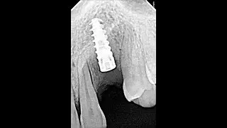 What is Dental Implant?