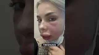 Failed lip reduction procedure