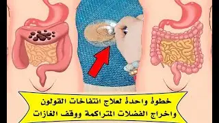 خطوة واحدة لعلاج انتفاخ القولون واخراج الفضلات المتراكمة ووقف الغازات