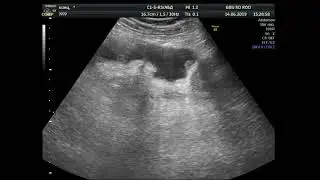 Канцероматоз брюшины . Рецидив рака яичника.