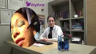 Daphne Lazer Fraksiyonel Lazer İle Sivilce İzi Tedavisi Uzman Dr Yeşim Tekin