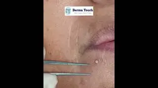 Milia Near lips