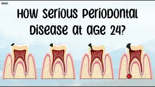 How Serious Periodontal Disease at age 24?🦷