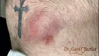 Drainage of a deep abscess on the back