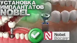 Установка имплантатов Nobel и костная пластика биоматериалом OsteoBiol Apatos