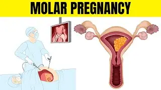 Molar Pregnancy (Hydatidiform Mole) - Types, Causes, Signs & Symptoms, Diagnosis, And Treatment