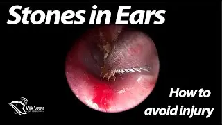 How to remove a stone from an ear (and how not to!)