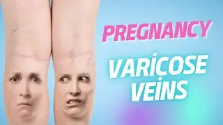 VARICOSE VEINS | PREGNANCY |  PREGNANCY PERIOD