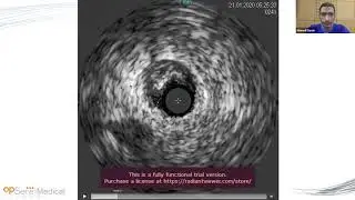 OptoWire: The New Fiber-Optic Pressure Wire Making a difference in complex PCI