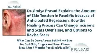 Why Skin is Pulled Tight by Surgeons in a Facelift and How Scars and Pixie Ears can be Revised
