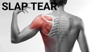 SLAP TEAR causes and symptoms/ SLAP LESSION क्या होता है?? #physiotherapy #medicaleducation
