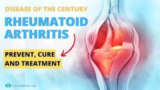 Disease of the Century - Rheumatoid Arthritis | Causes, prevention and Treatment