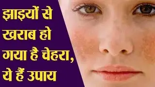 झाईयो के लिए घरेलू नुस्खे || झाईयो से है परेशान तो अपनाएं Home Remedy | Pigmentation| Melasma