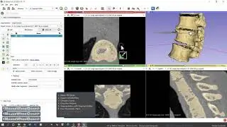 CT or MRI to 3D print  DICOM to STL with Local computer Part 1 of 2