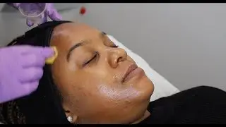 The Perfect Peel | The Laser and Skin Clinic