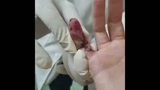 Fisioterapia na lesão do quinto dedo @Antonio Vital Sampol