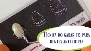 Técnica do Gabarito para Dentes Anteriores