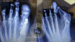 First Metatarsophalangeal (MTP) Joint Fusion | Bunion | Big Toe Fusion
