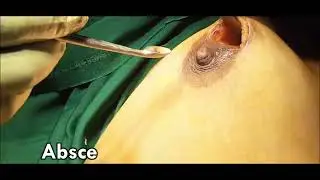Scarless Drainage Of Breast Abscess Breast Infection, Breast Surgery in Bharuch, Valsad, Surat, Vapi