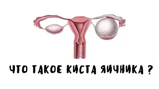 Что такое киста яичника ?