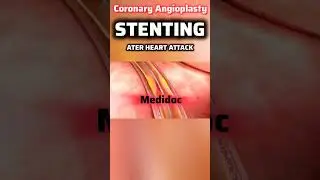 Coronary Angioplasty OR Coronary Stenting #angioplasty #coronaryheartdisease