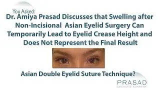 Why Eyelid Surgery, Just Like Eye Rubbing, can Cause Temporary Swelling in Eyelid Skin