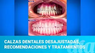 Calzas dentales desajustadas, consejos, recomendaciones y tratamientos