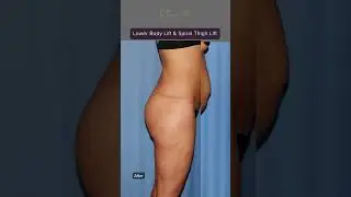 Lower Body Lift & Spiral Thigh Lift Before & After ⏳