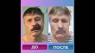 Паралич лица. Лицевой нерв.