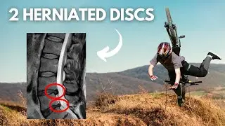 L4L5 L5S1 Disc Herniation + Severe Foot Drop Recovery online program